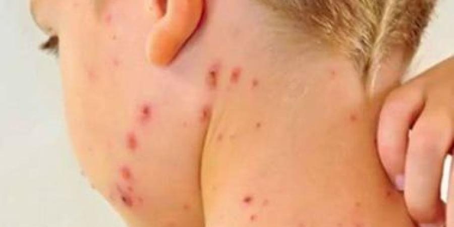 الصحة تحذر من انتشار الحصبة بين الأطفال وتدعو للاستفادة من حملة التطعيم المجانية :اليوم السابع