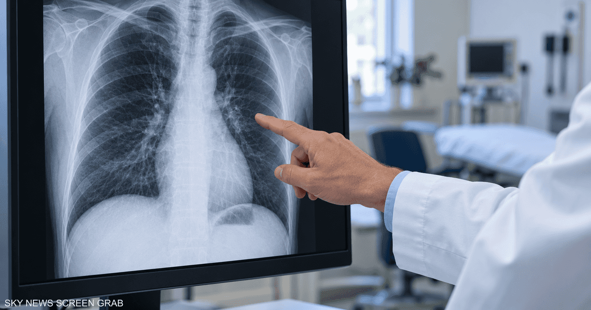 سرطان الرئة.. لماذا يختبر العلماء تقديم العلاج أبكر؟