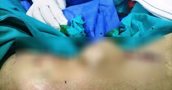 إنجاز فريد من نوعه لإنقاذ حياة مريض بمستشفى الفكرية المركزى جنوب المنيا