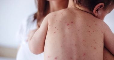 الصحة: تطعيمات الحصبة مجانًا للأطفال من عمر 9 شهور حتى 10 سنوات